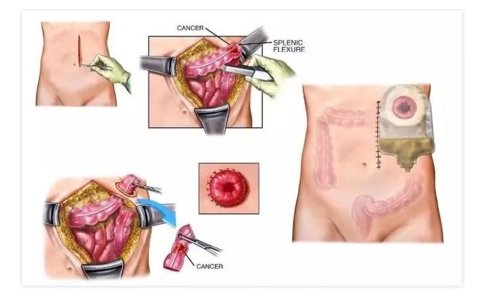 在中国，有100万人因肠癌失去肛门...医生也不能幸免(图2)