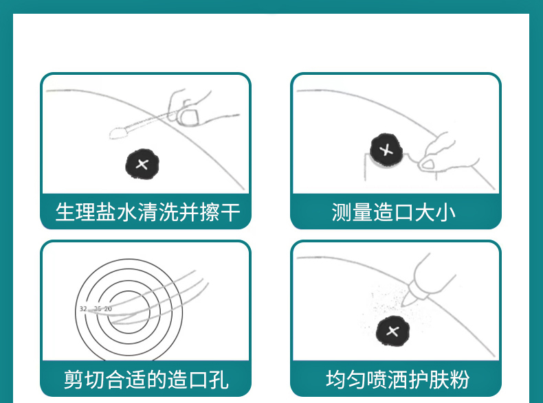 科普|如何让玫瑰绽放——如何护理泌尿回肠造口(图5)