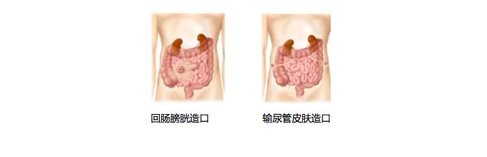 科普|如何让玫瑰绽放——如何护理泌尿回肠造口(图3)