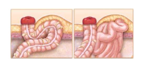 造口的严重后果——造口旁疝(图2)